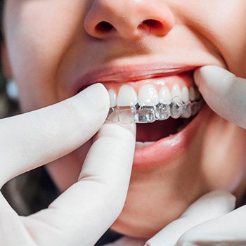 Dentist putting clear aligner on patient