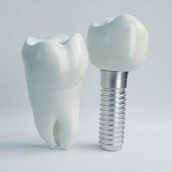 model of a real tooth next to a dental implant in Oak Cliff 