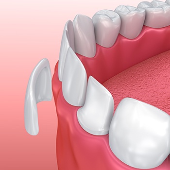 Animation of porcelain veneer placement