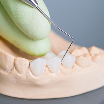 Model smile with fixed bridge restoration