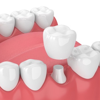 Illustration of dental crown in Oak Cliff, TX being placed on tooth