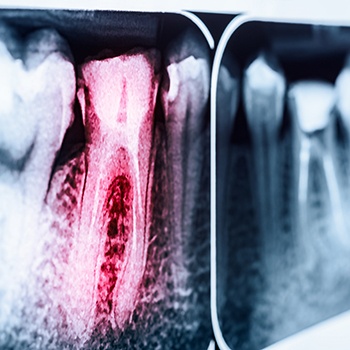 X-ray of root canal treated tooth