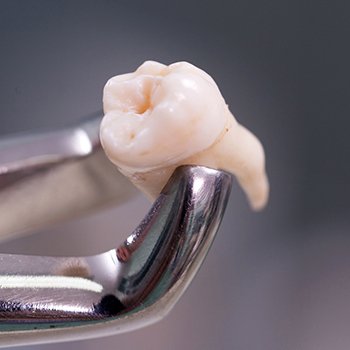 Metal clasp holding extracted tooth