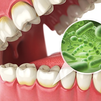 Plaque and bacteria gathering near the gumline