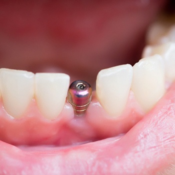 closeup of single dental implant