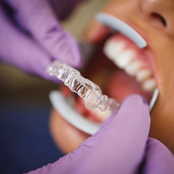 dentist putting Invisalign aligner on patient