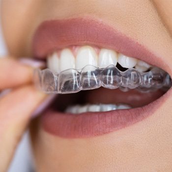 Patient putting clear aligner on top teeth