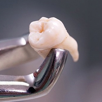 Closeup of tooth after tooth extraction in Oak Cliffs