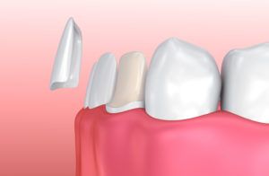 Porcelain veneer image