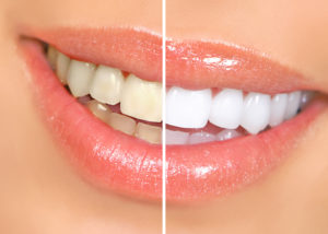 Closeup of before and after teeth whitening in Oak Cliff