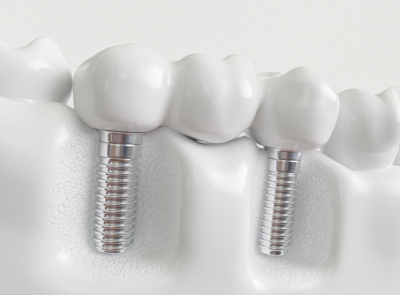 a mouth mold that contains an implant bridge in Dallas