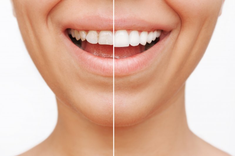 before and after shot of someone with veneers