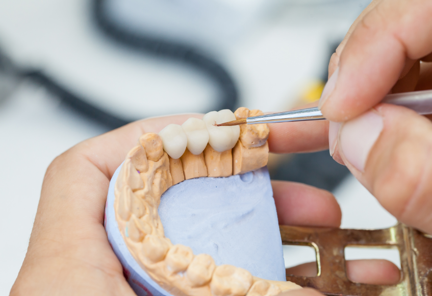 Model of a dental crown